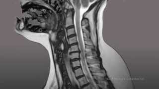 3D Precision Diagnostics Cervical Spine Injuries MRI [upl. by Ahsenev]