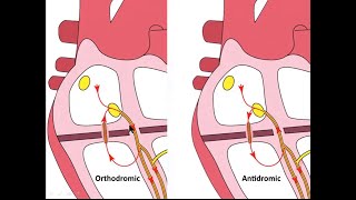 ECG part 3 SVT Atrioventricular reentry tachycardia AVRT [upl. by Kery]