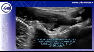 How to capture iliopsoas snapping hip on ultrasound [upl. by Ydnyl269]