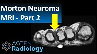 MRI of Morton Neuroma  part 2 [upl. by Esile103]