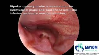 Turbinate Hypertrophy  Submucosal Diathermy Reduction by Dr Manish Prakash Mayom Hospital Gurgaon [upl. by Mal856]