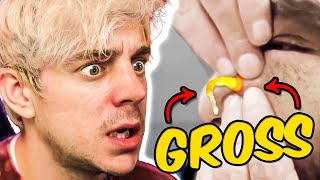 Reacting to the Grossest Pimple Popping Videos [upl. by Desirae]