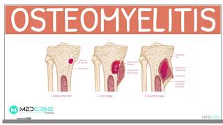 Osteomyelitis Classification Causes Pathophysiology Signs and Symptoms Diagnosis and Treatment [upl. by Cletis875]