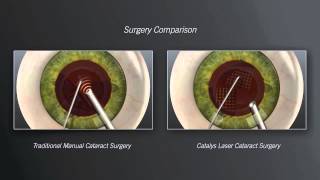 Catalys Laser Cataract Surgery vs Traditional Manual Cataract Surgery  Animation [upl. by Airotnahs710]