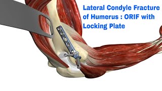 humerus lateral condyle fracture  reduction and fixation with plate [upl. by Kliment211]