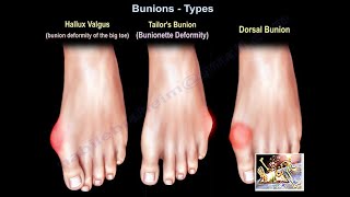 Bunions Types  Everything You Need To Know  Dr Nabil Ebraheim [upl. by Riannon]