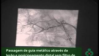 Angioplastia de Artéria Renal [upl. by Licastro]