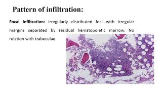 Chronic Lymphocytic Leukemia Small Lymphocytic Lymphoma [upl. by Atikahc242]