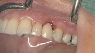 NobelActive clinical case immediate implant placement  Eric Rompen [upl. by Marylynne293]