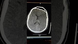 Left MCA territory CVA ischemic stroke ct scancytotoxic edema both whitegray matter hypodensity [upl. by Ecirtal]