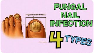 4 TYPES OF FUNGAL NAIL INFECTIONS YOU MAY HAVE TOENAIL FUNGUS [upl. by Harmonia201]