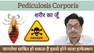 शरीर का जूँ  Body Lice  जानलेवा साबित हो सकता है इससे होने वाला इन्फेक्शन  Pediculosis Corporis [upl. by Nomrej46]