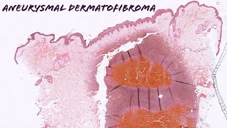 Aneurysmal dermatofibroma dermatofibroma with internal hemorrhage pathology dermpath dermatology [upl. by Damara398]