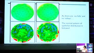 HEALING OF EPITHELIUM AND ITS IMPACT ON REFRACTIVE SURGERY DR CHINTAN MALHOTRA [upl. by Yllas88]