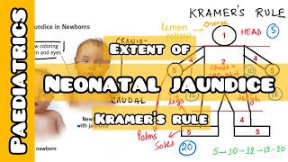 How to asses extent of Neonatal Jaundice by Kramer’s Rule  USMLE NEET PG INICET NCLEX [upl. by Ettenav]