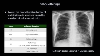 How to Interpret a Chest XRay Lesson 8  Focal Lung Processes [upl. by Farron]