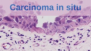 What is Carcinoma in situ  Pathology mini tutorial [upl. by Jany488]