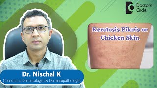 How to get rid of KERATOSIS PILARIS or CHICKEN SKIN expertskisuno Dr Nischal K Doctors Circle [upl. by Fong]