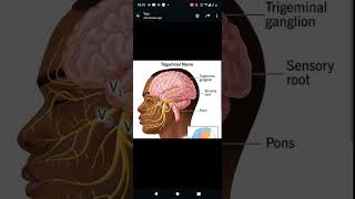 icecream headache brainfreeze colddrinks trigeminalnerve brain symptoms causes medicine [upl. by Jaquiss]