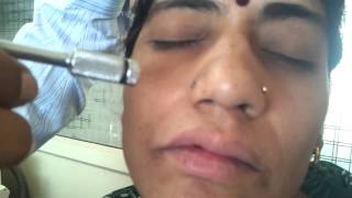 Cryo on Basal cell carcinoma by Dr Bhutada [upl. by Nuahsad]