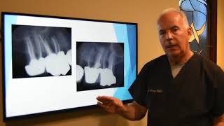 Updated Information on Root Canals and Treatments by Dr Dana Rockey [upl. by Ebba]