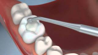 Composite Filling [upl. by Norak]