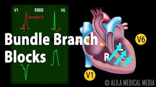 Bundle Branch Block Animation [upl. by Aicirtan]