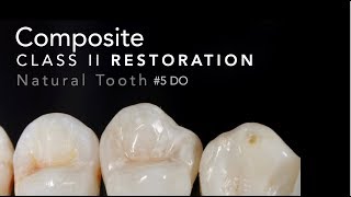 Class II Composite Restoration  5 DO Natural Tooth [upl. by Notle479]