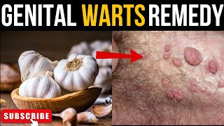 NATURALLY REMOVE GENITAL WARTS WITH GARLICgenitalwarts wartstreatment naturalremedy [upl. by Fulks]