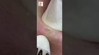 Blackheads Removal  Acne Treatment and Very Satisfying Satisfying Pimple pop blackheads [upl. by Celina]