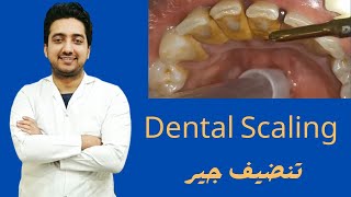 20 Years of Dental Calculus Removed with Ultrasonic Scaler  Tartar And Calculus Removal Part 1 [upl. by Etnoel]