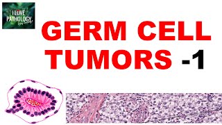 OVARIAN TUMORS  Part 4 Germ cell tumors Dysgerminoma yolk sac tumor  Pathology [upl. by Aztin92]