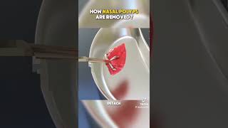 How Nasal Polyps are removed [upl. by Ycats]