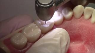 Tutorial on Class I Cavity Preparation Amalgam Restoration  DENTALKART [upl. by Sikleb206]