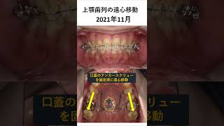 過蓋咬合の矯正歯科治療 歯医者 dentist 歯列矯正 [upl. by Loftis]