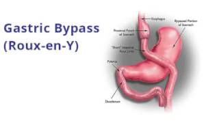 The two types of bariatric surgery [upl. by Liponis]