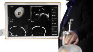 RealTime Updates with Brainlab Ultrasound Integration [upl. by Legge]