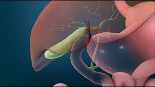 Surgery to Remove Your Gallbladder Open Cholecystectomy [upl. by Salakcin]