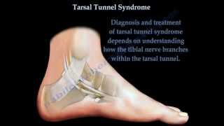 Tarsal Tunnel Syndrome  Everything You Need To Know  Dr Nabil Ebraheim [upl. by Ilojne]