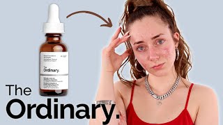 The Ordinary Salicylic 2 Anhydrous Solution Review  Does It Work For Blemish prone skin [upl. by Saidee]