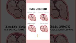 4 Types of twins medically Twin pregnancies pregnant youtubeshorts twins September 4 2024 [upl. by Kylstra]