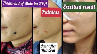 Mole removal by RFA  permanent removal of Melanocytic Nevus Dehradun  Treatment of Mole by RFA [upl. by Ecniuq692]