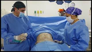 Cirugía Abdominal Abdominoplastia con Lipoescultura [upl. by Oiretule]