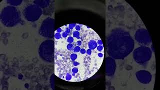 Differential Count with Atypical cells seen  Pleural Fluid Analysis [upl. by Jahdiel236]