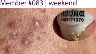 Acne Treatment Huong Da Nang 083  Member [upl. by Niwde]