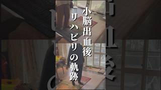 【小脳出血後リハビリの軌跡】手足の震えとバランス障害が顕著だったお客様 [upl. by Lirba]