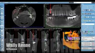 Straumann Romexis Fully Guided Workflow [upl. by Aimaj]