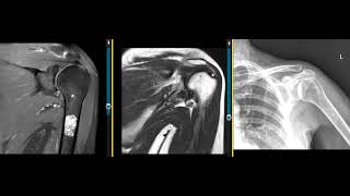 Enchondroma of humerus [upl. by Ahsein]