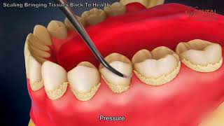 Periodontics  NonSurgical Therapy  INBDE ADAT [upl. by Asteria]