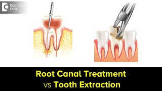 Root Canal Treatment vs Tooth Extraction Which one is betterDr Shahul Kamal AsifDoctors Circle [upl. by Lashonda]